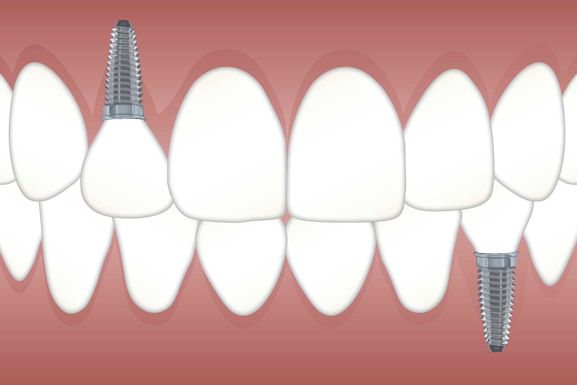 what dental implants look like diagram